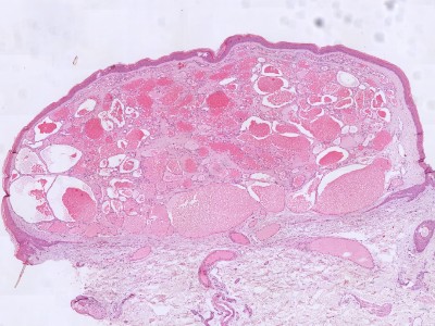 Histologie caverneus hemangioom