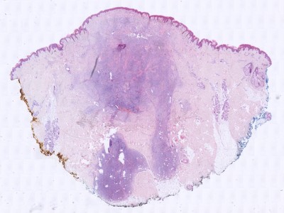 Histologie cellular blue nevus