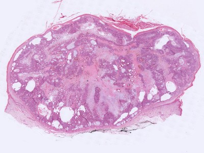 Histologie chondroid syringoma