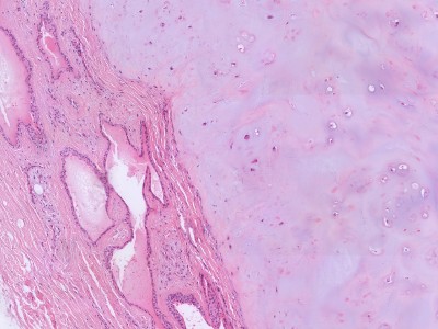 Histologie chondroid syringoma