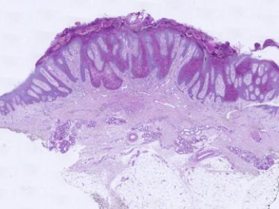 Histologie clear cell acanthoma (PAS kleuring)