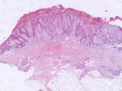Histologie clear cell acanthoma