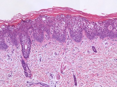 Histologie congenitale ichthyosiforme erythrodermie