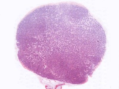 Histologie cylindroma