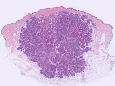 Histologie cylindroma