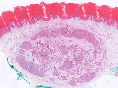 Histologie dermal duct tumor