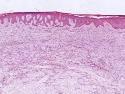 Histologie dermatofibroom