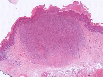 Histologie dermatofibroom