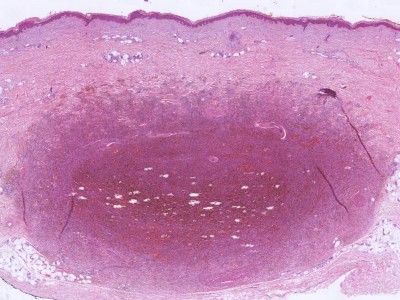 Histologie dermatofibroom