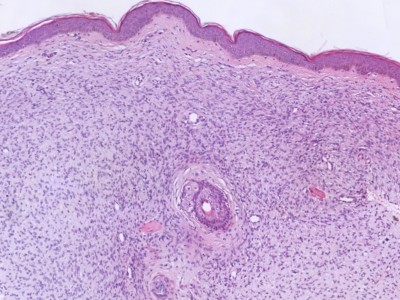Histologie dermatofibrosarcoma protuberans