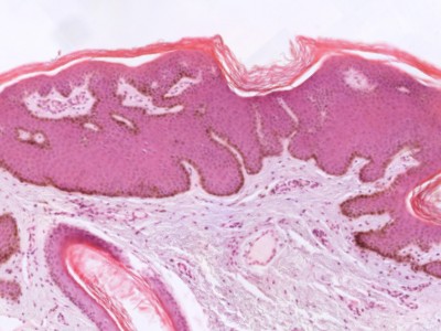 Histologie dermatosis papulosa nigra