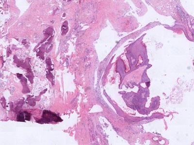 Histologie dermoid cyste