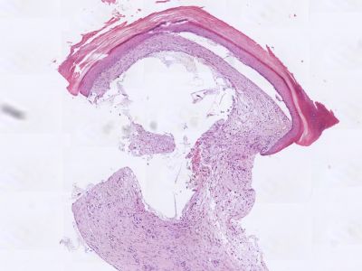 Histologie mucoid cyste
