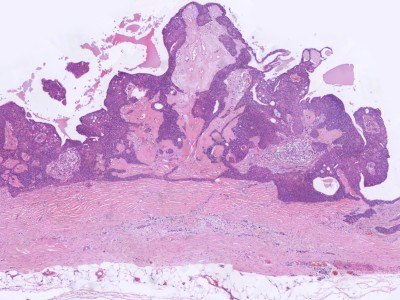 Histologie eccrien hidradenoma