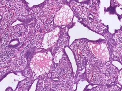 Histologie eccrien hidradenoma