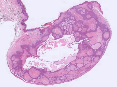 Histologie eccrien syringofibroadenoma