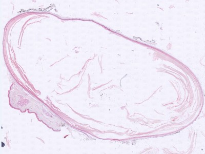 Histologie epidermoid cyste