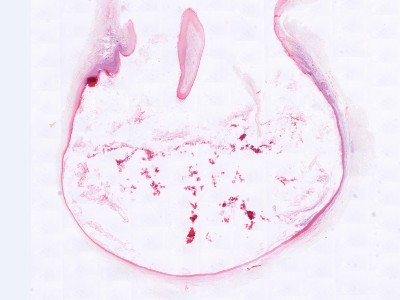 Histologie epidermoid cyste