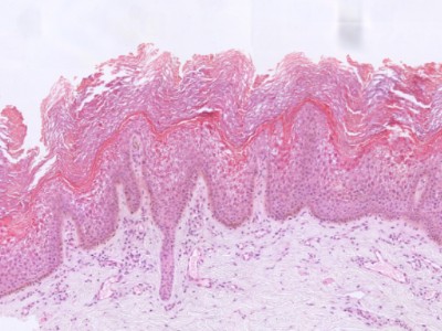 Histologie epidermolytische hyperkeratose