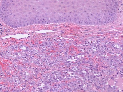 Histologie epithelioid angiosarcoma
