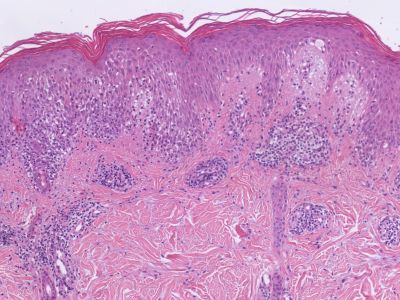 Histologie erythema multiforme
