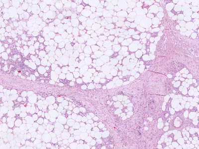 Histologie erythema nodosum