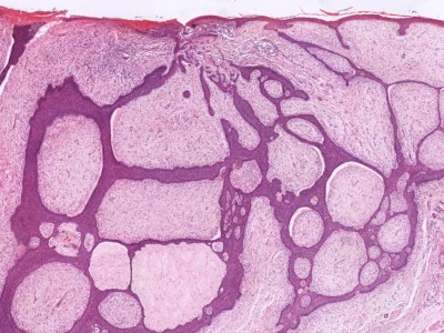 Histologie fibroepithelioma