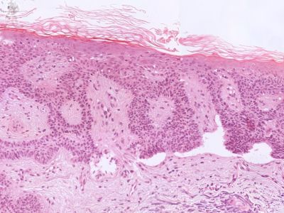 Histologie fibroepithelioma