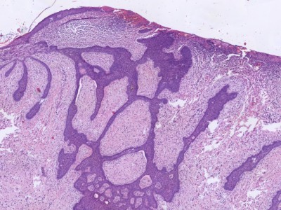 Histologie fibroepithelioma