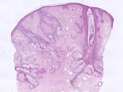 Histologie fibrofolliculoma
