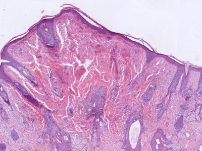 Histologie fibrous papule of the nose