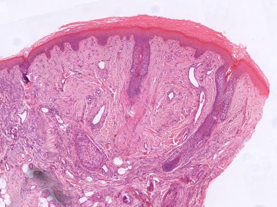 Histologie fibrous papule of the nose