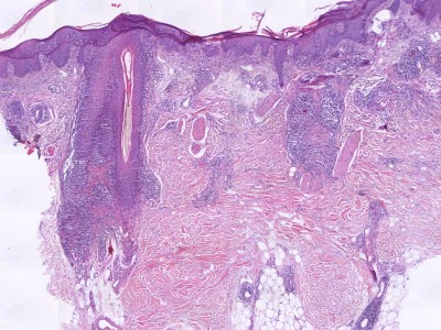 Histologie folliculotrope mycosis fungoides