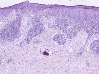 Histologie folliculotrope mycosis fungoides