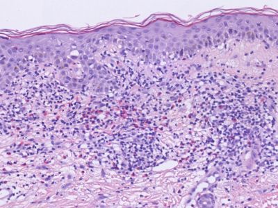 Histologie geneesmiddelreactie