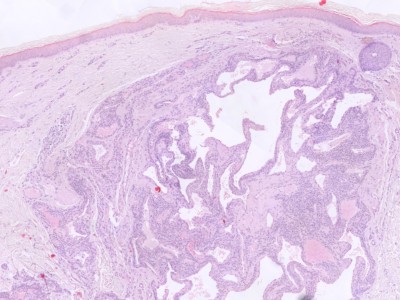 Histologie glomangioom