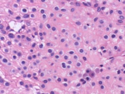 Histologie glomangioom