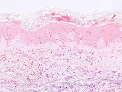 Histologie graft-versus-host disease