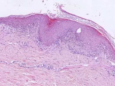 Histologie graft-versus-host disease
