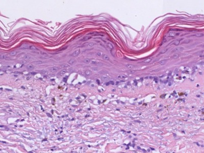 Histologie graft-versus-host disease