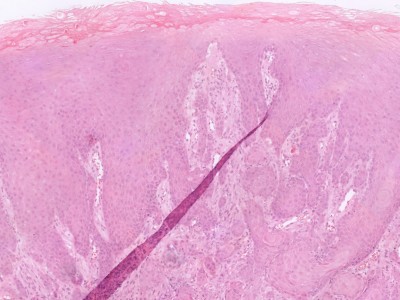 Histologie granular cell tumor