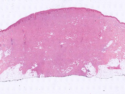 Histologie granular cell tumor