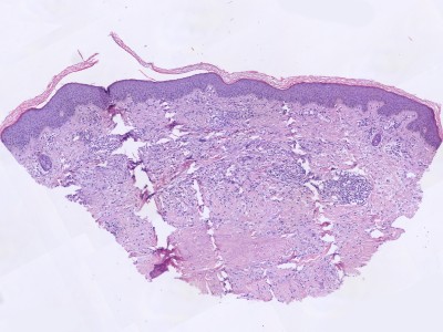 Histologie granuloma annulare