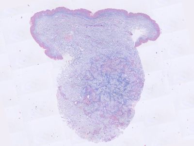 Histologie granuloma annulare, Alcian blue kleuring
