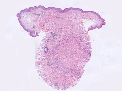 Histologie granuloma annulare