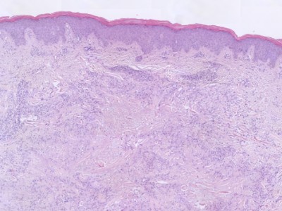 Histologie granuloma annulare