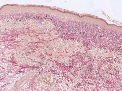 Histologie granuloma annulare, EVG kleuring