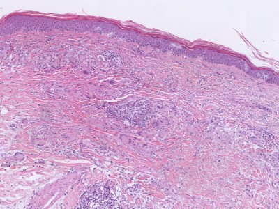 Histologie granuloma annulare