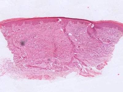 Histologie granuloma annulare, necrobiotisch