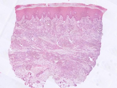Histologie granuloma annulare, necrobiotisch
